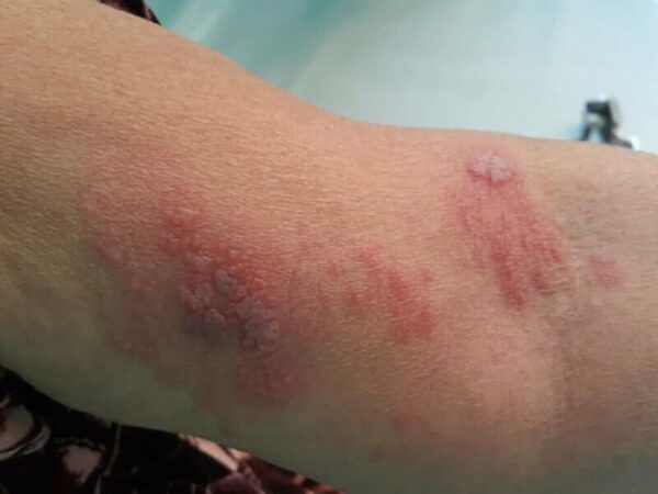 CBD for shingles rash, How to catch shingles?, What foods should you avoid when you have shingles?, What makes shingles flare up?, What is the fastest way to cure shingles?, How can you get shingles?, Where is the most painful place to get shingles?, Can you catch shingles by being near someone?, What triggers shingles to activate?, Is shingles caused by stress?, Can I stop shingles from spreading?,